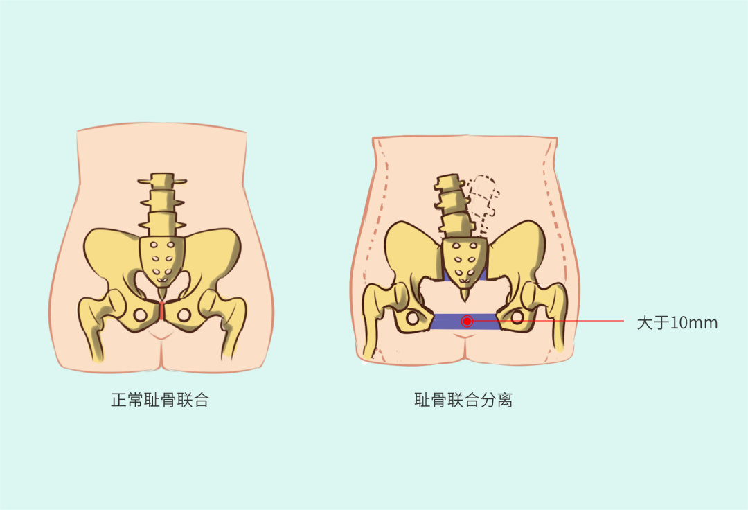 恥骨聯合2.png